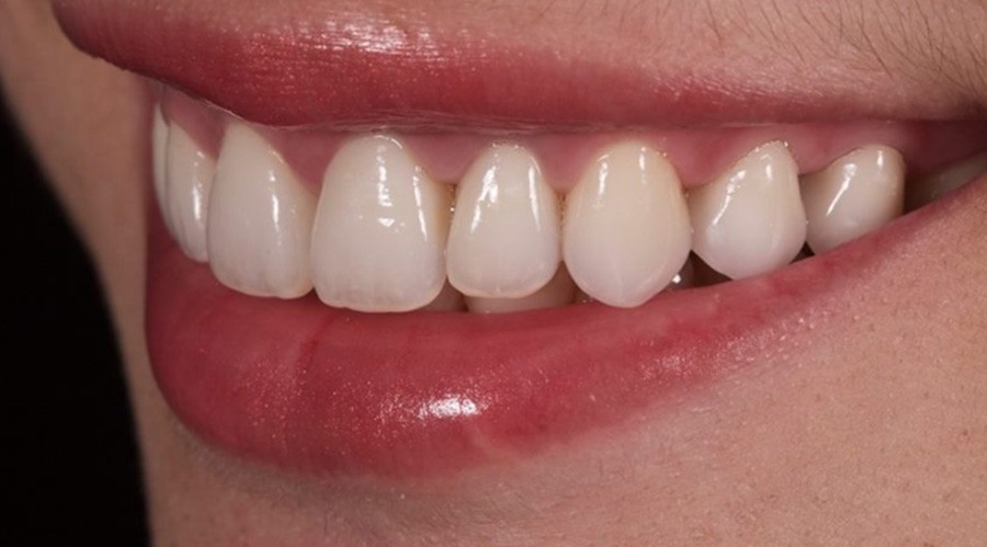 قبل تركيبات-اسنان